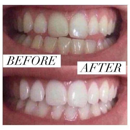 Professional Instant Teeth Whitening Pen Image 3