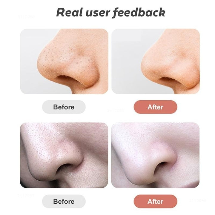 Visual Blackhead Remover Facial Cleaner Nose Deep Pore Remover Acne Pimple Removal Vacuum Suction Image 3